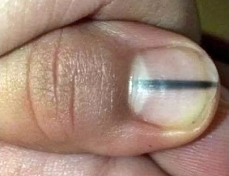 Linha preta na unha pode indicar que a sua saúde está em perigo ...